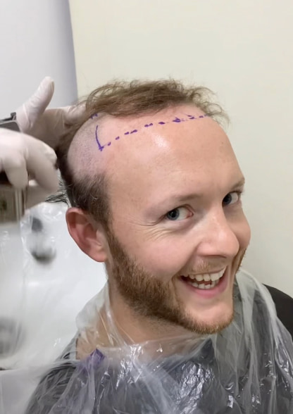 Hair transplant for androgenetic alopecia