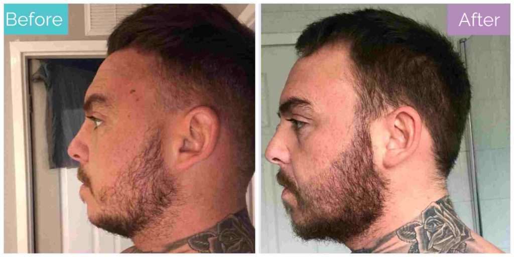 3 months after beard transplant