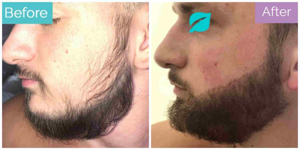 6 months after beard transplant 