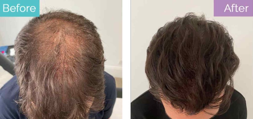 SMP to treat hair loss