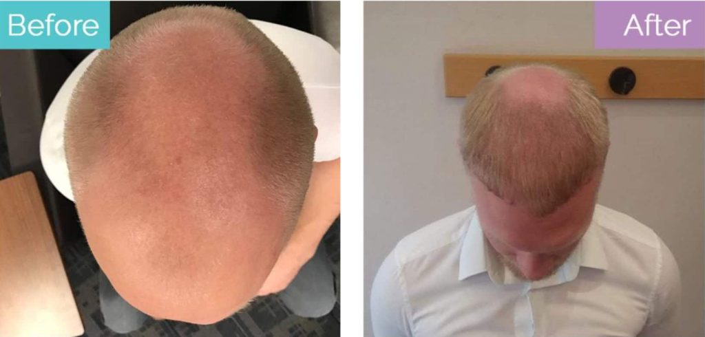 Second hair transplant candidate