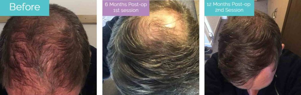 second FUE hair transplant before and after