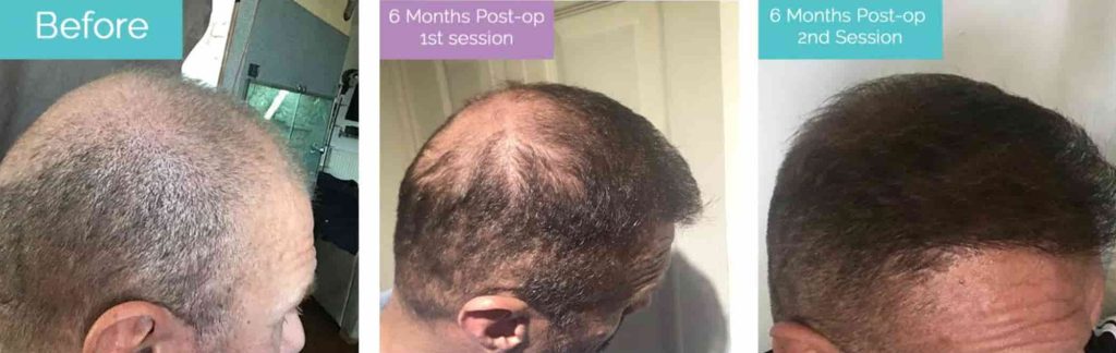 second hair transplant before and after