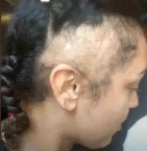 Tight hairstyle hair loss