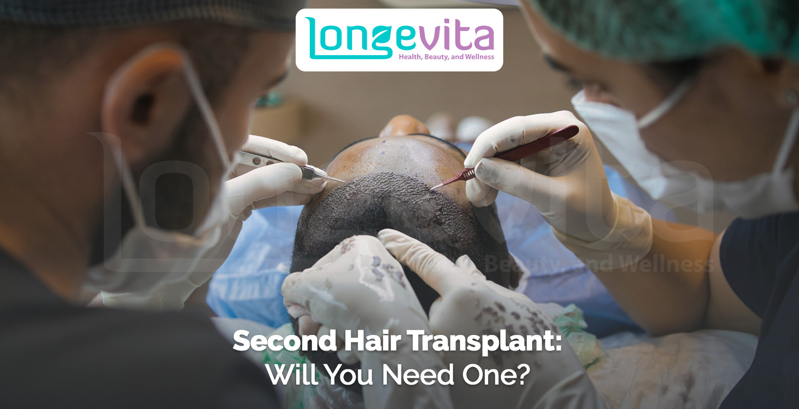 surgeons performing hair transplant procedure on patient's scalp with text about needing a second transplant