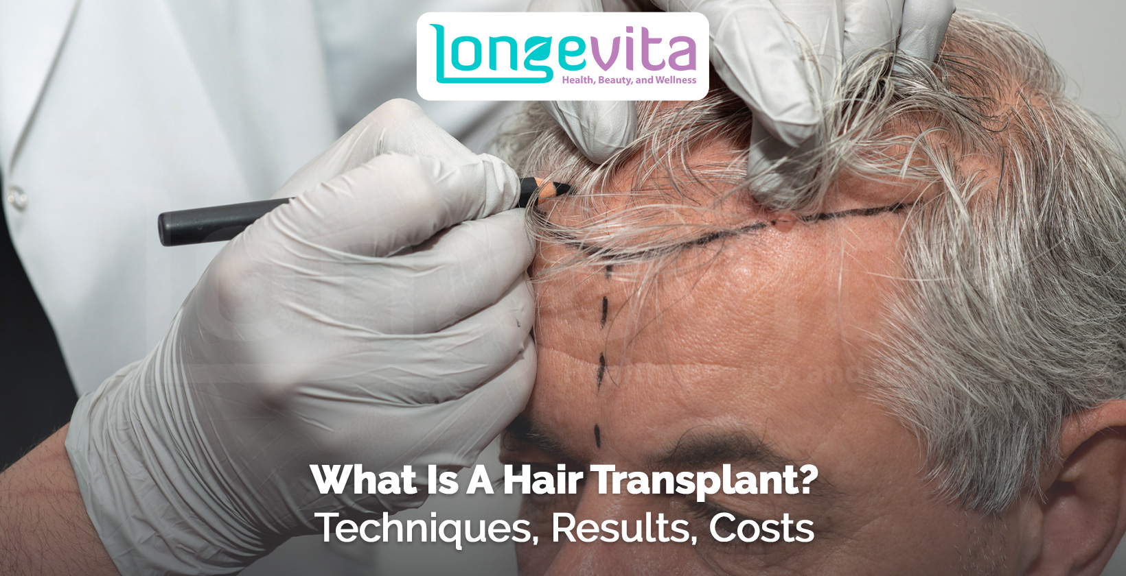 doctor marking a patient’s hairline with text about hair transplant techniques results and costs