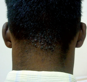 Acne keloidalis neck hair loss