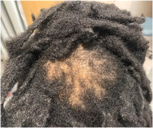 Central centrifugal cicatricial alopecia