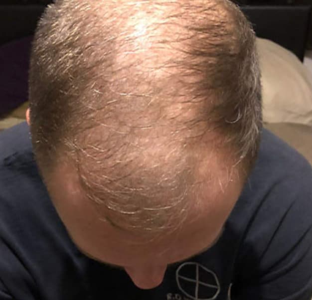 Classic androgenetic alopecia