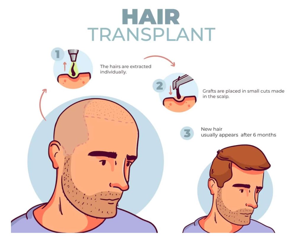 Donor area for hair transplantation