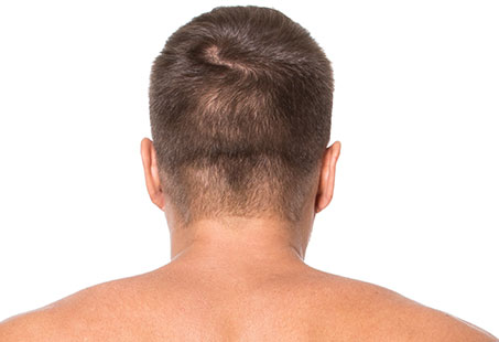 Hair loss at nape of neck