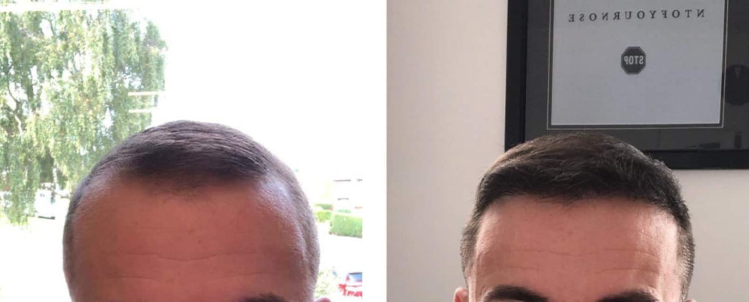 Receding Hairline Signs, Causes, Ways To Hide & Stop It Longevita