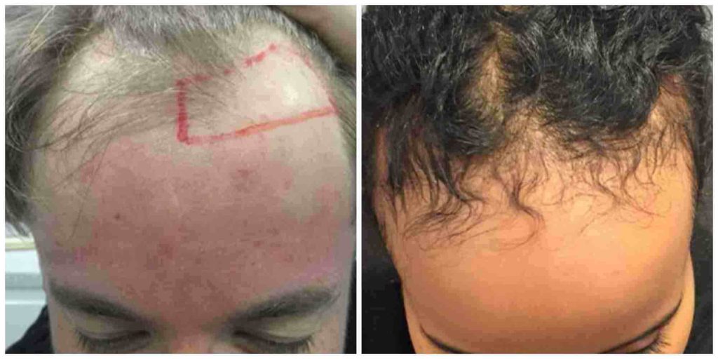 Male and female hairline recession
