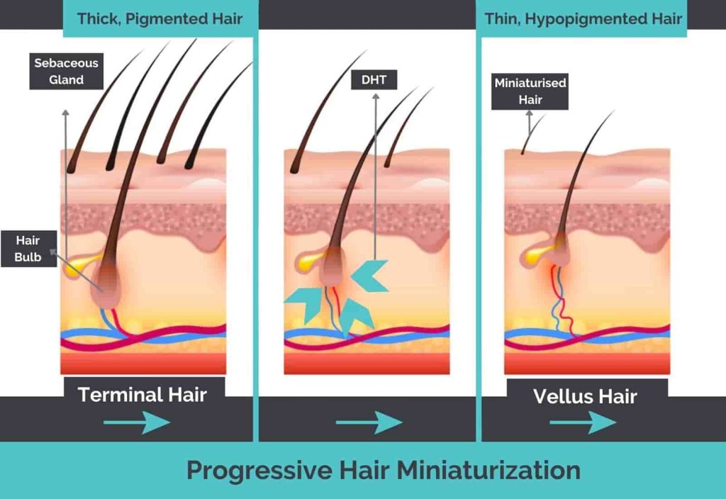 Stages of follicular miniaturization