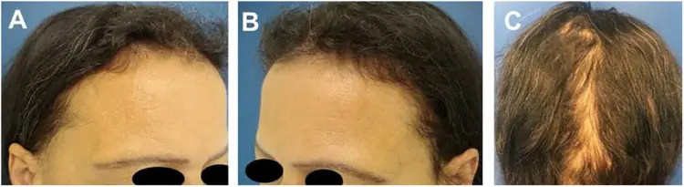 glutathione clears acne Glowing Skin: IV Glutathione and Vitamin C