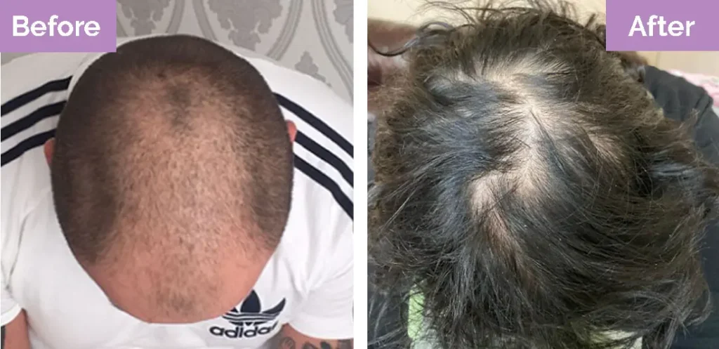 Androgenetic Alopecia before after 2