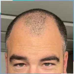 Androgenetic alopecia