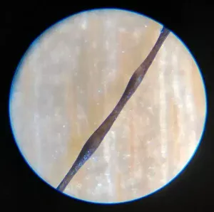 Monilethrix neck hair loss