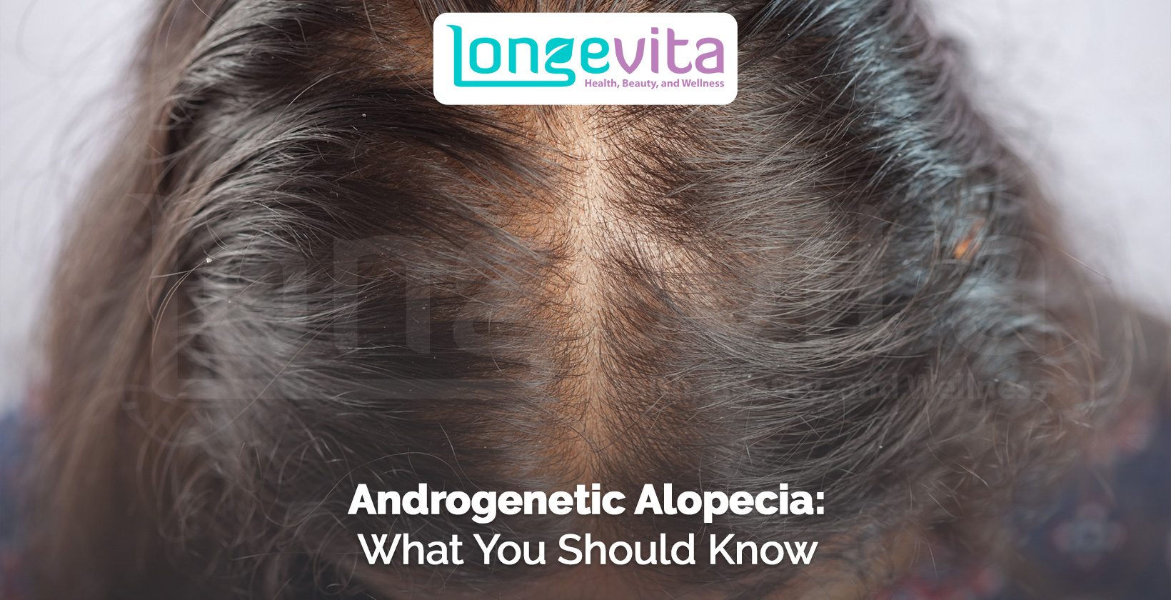 top view of scalp with thinning hair and text about androgenetic alopecia