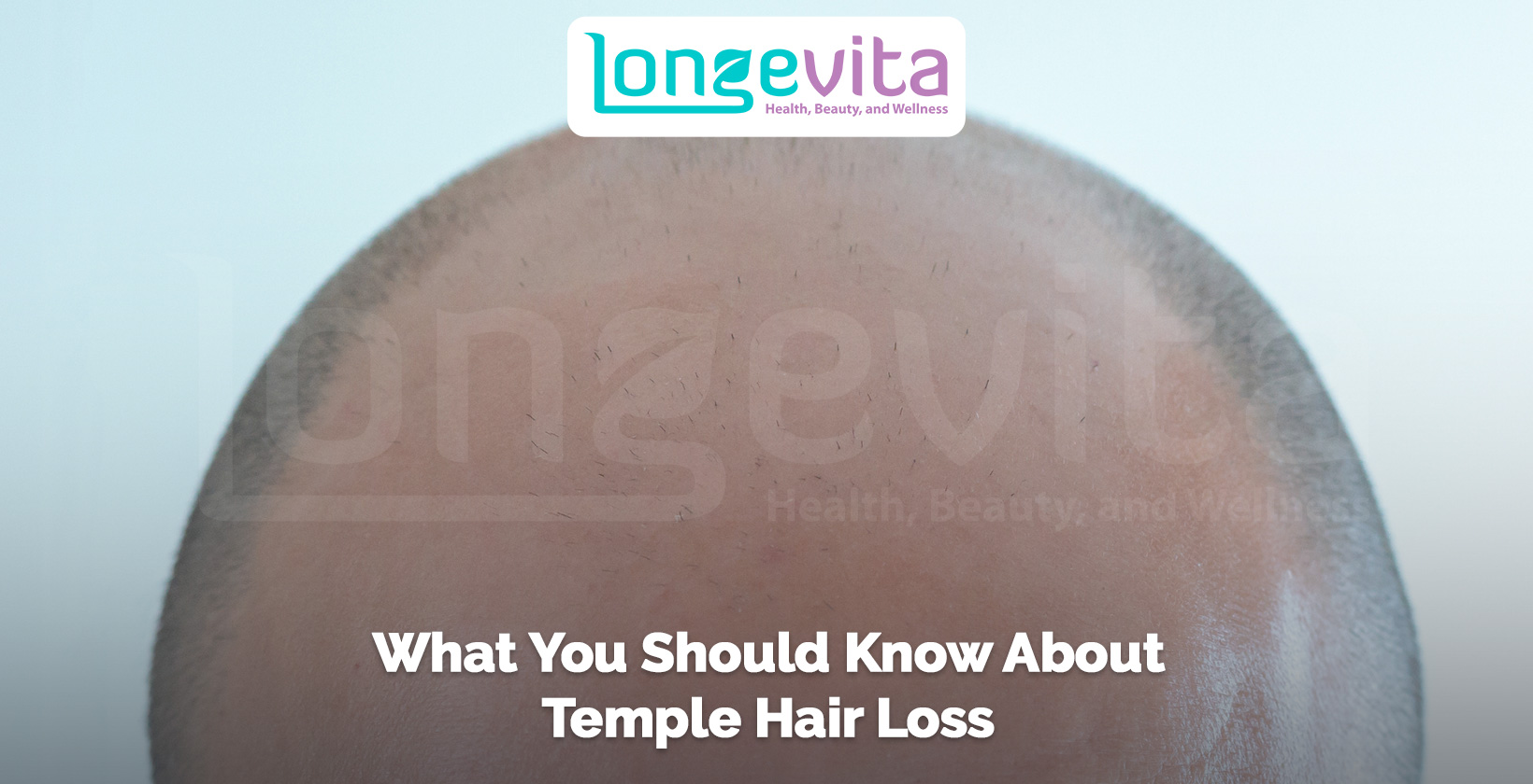 close-up of a bald scalp with thinning at the temples and text about temple hair loss