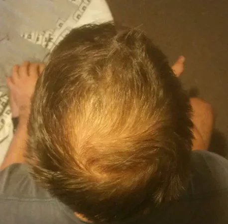 thin crown hair