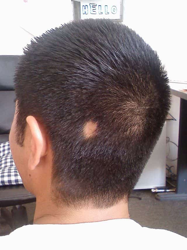 Alopecia areata bald patch