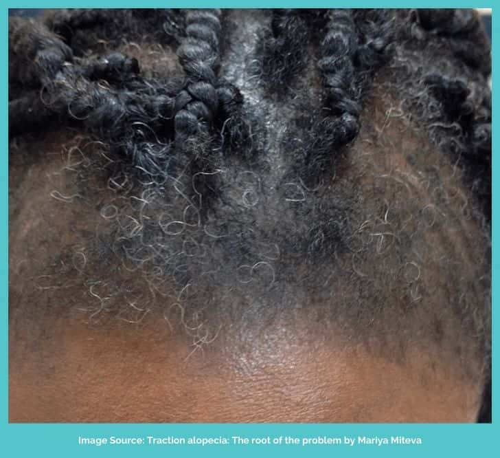 Marginal traction alopecia