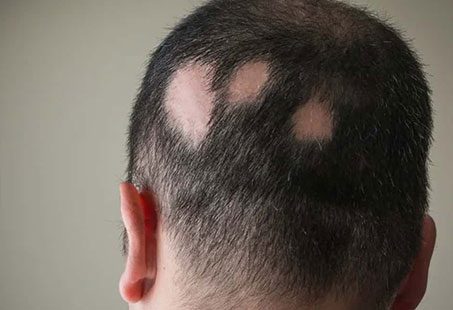 Multiple alopecia areata spots