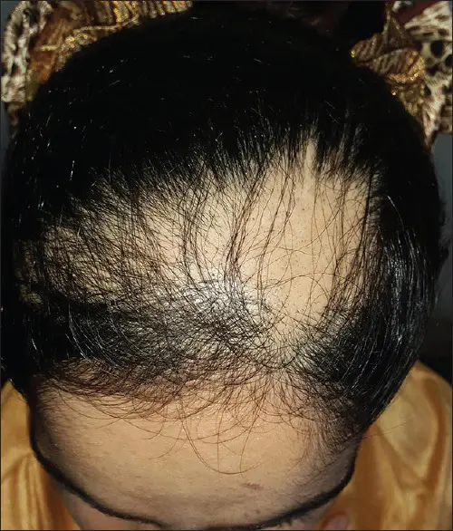 Traction alopecia 2