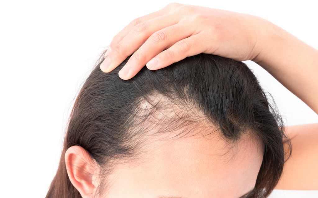 Traction alopecia bald spot