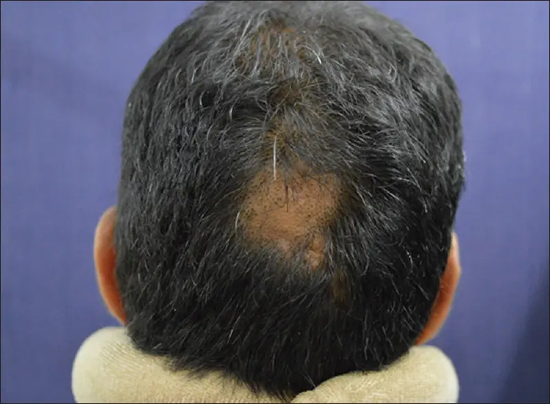 pressure alopecia