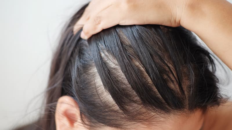 stress hair loss in women