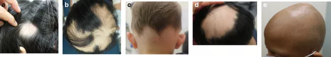 Alopecia Areata 2
