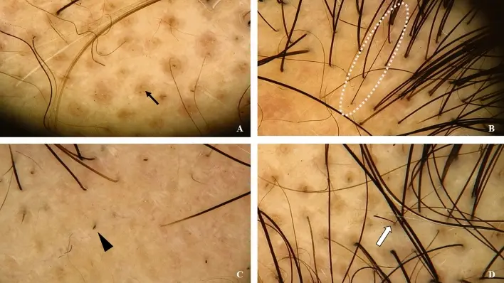 glutathione alopecia areata 101: What You Should Know IV Drips & Vitamin جلوتاثيون مختزل Size:2g x 30 sticks