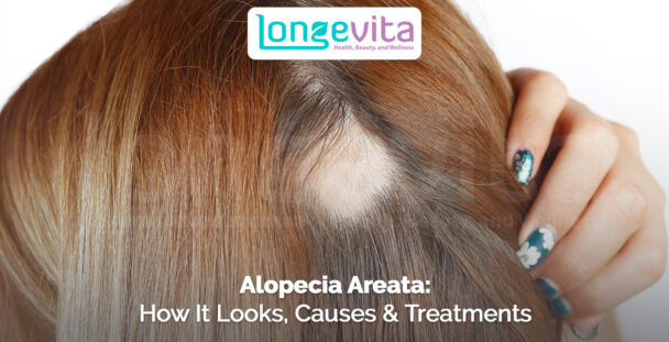 close-up of a woman parting her hair to reveal a bald patch with text about alopecia areata