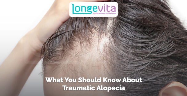 close-up of scalp with thinning hairline and text about traumatic alopecia
