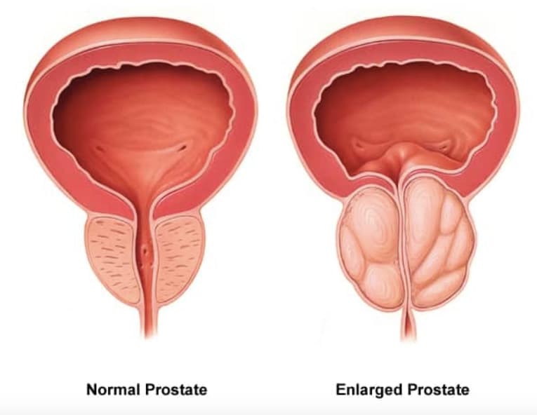 Abnormally enlarged prostate