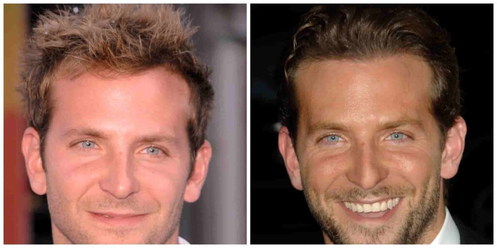 Bradley Cooper before and after alleged hair transplant