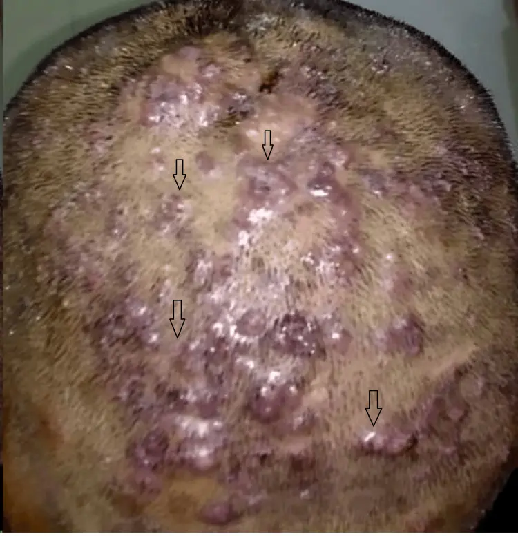 Folliculitis Decalvans 1