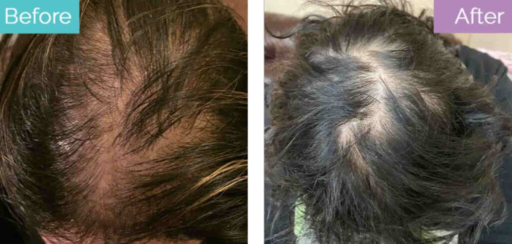 Hair transplant for female pattern hair loss