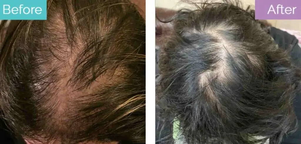 How To Stop Hair Loss After Steroid Cycle Hair Loss Due To Steroids: Causes & Solution | Longevita