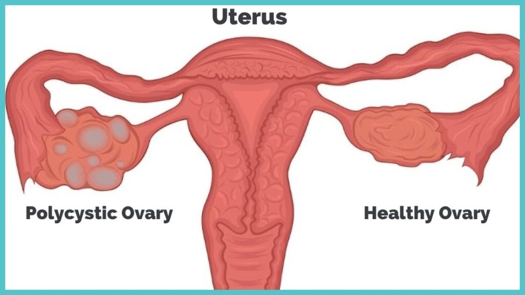Polycystic Ovary