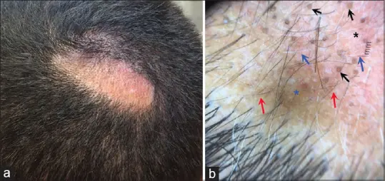 Pressure Alopecia 1