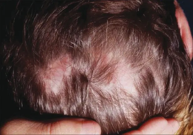 Pressure Alopecia 2