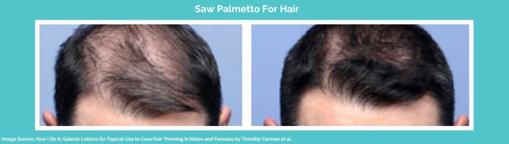 Saw palmetto before and after