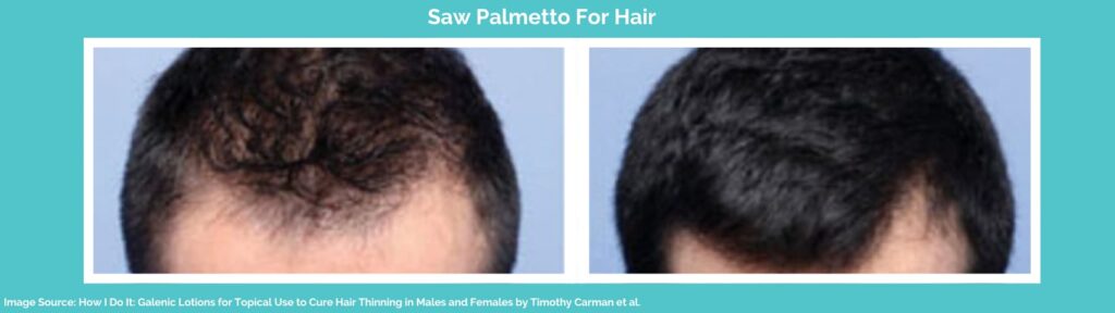 Saw palmetto for hair before and after