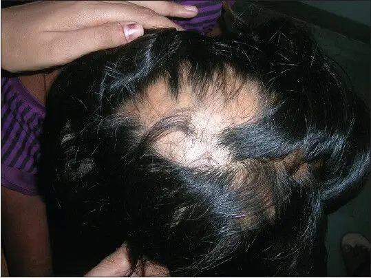 loose anagen syndrome 4