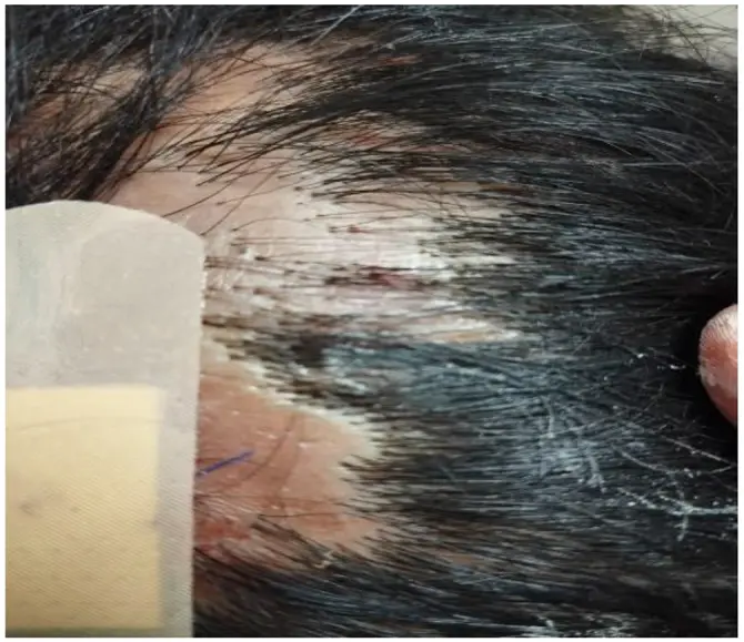 loose anagen syndrome 5