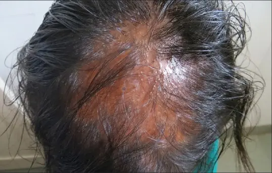 loose anagen syndrome 6