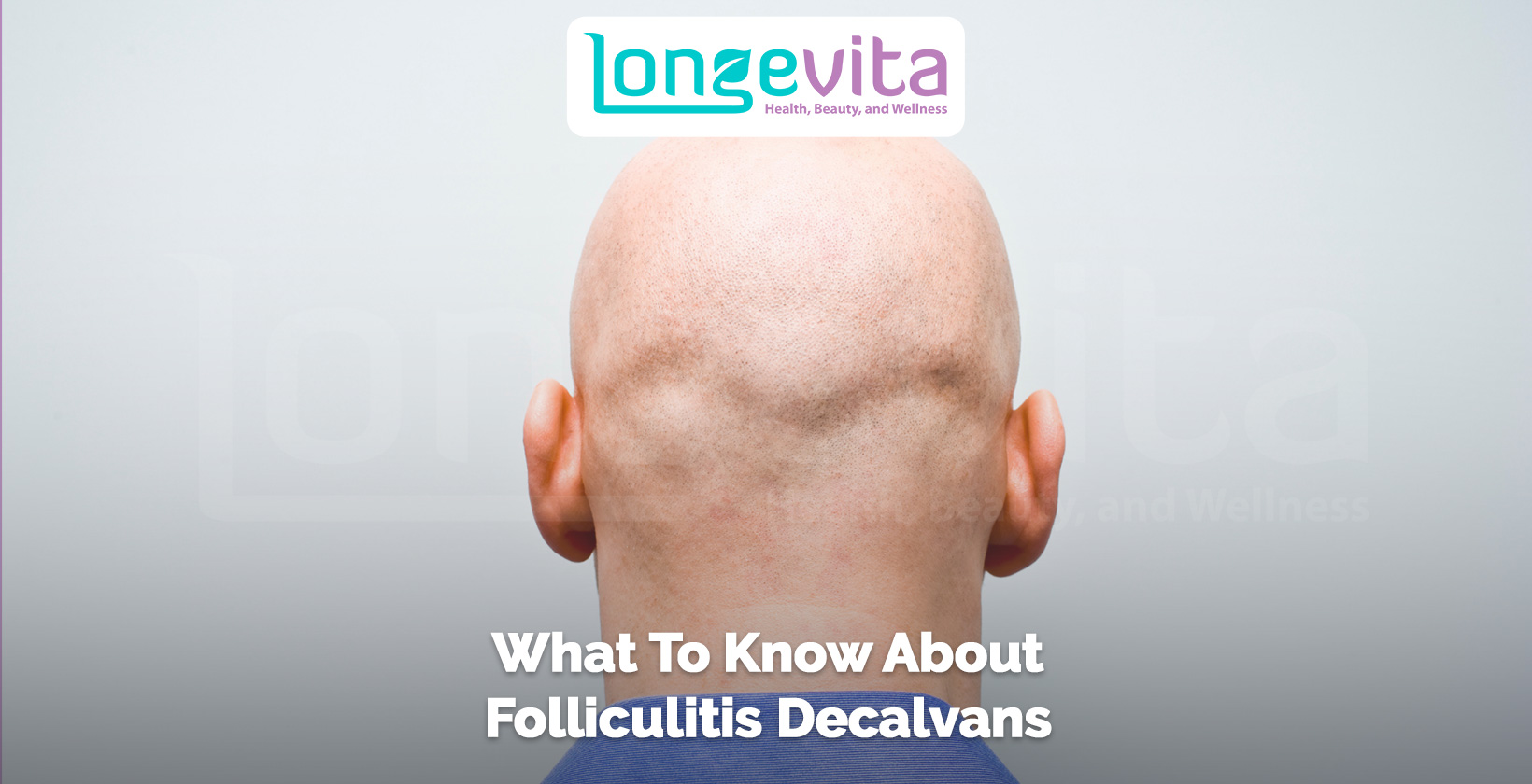 back view of a bald head with text about folliculitis decalvans